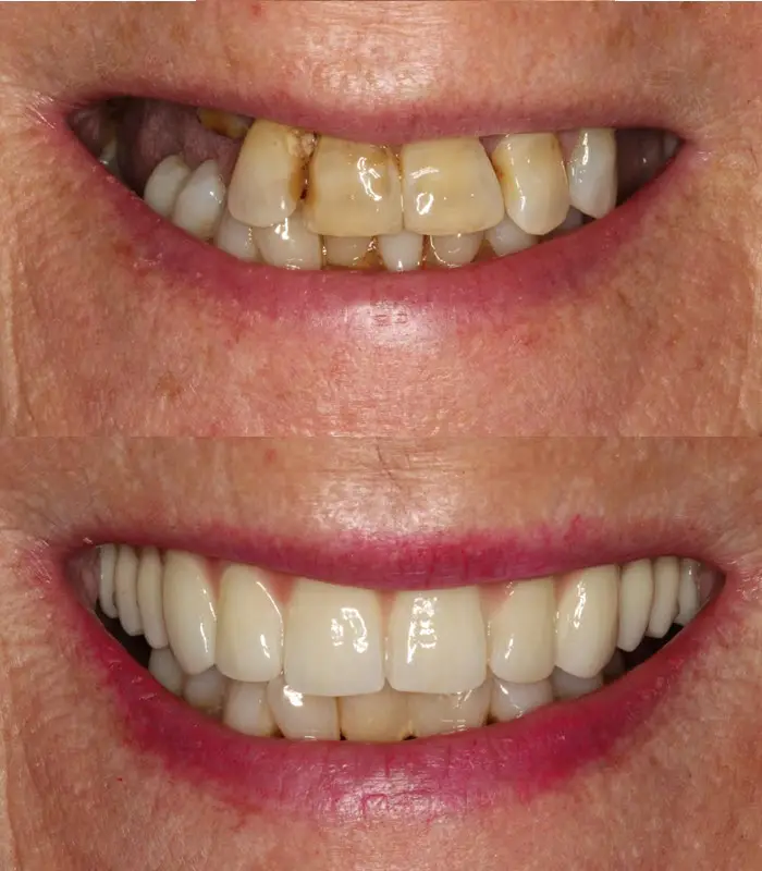 Erin : Dental Implant Treatment with Porcelain Bridge