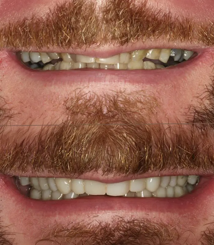 Gary : Invisalign and composite bonding