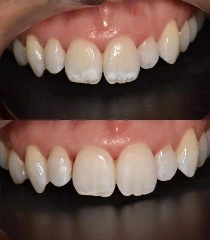 Sarah - whitespot treatment (upper)